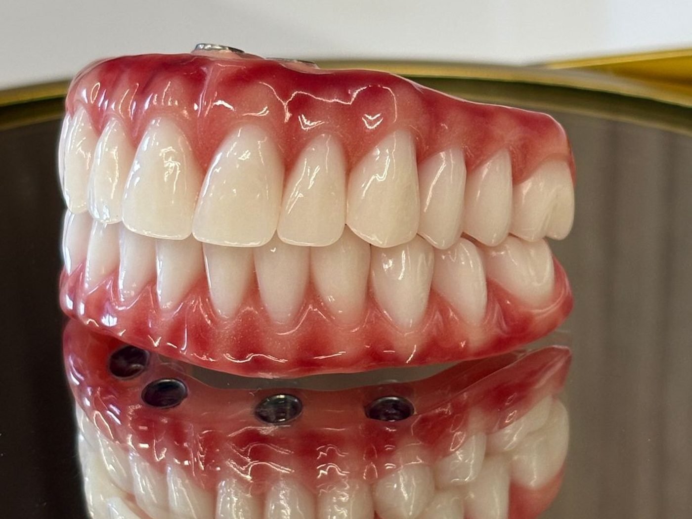 Prótese protocolo sobre implantes, trabalho da Fluari Odontologia